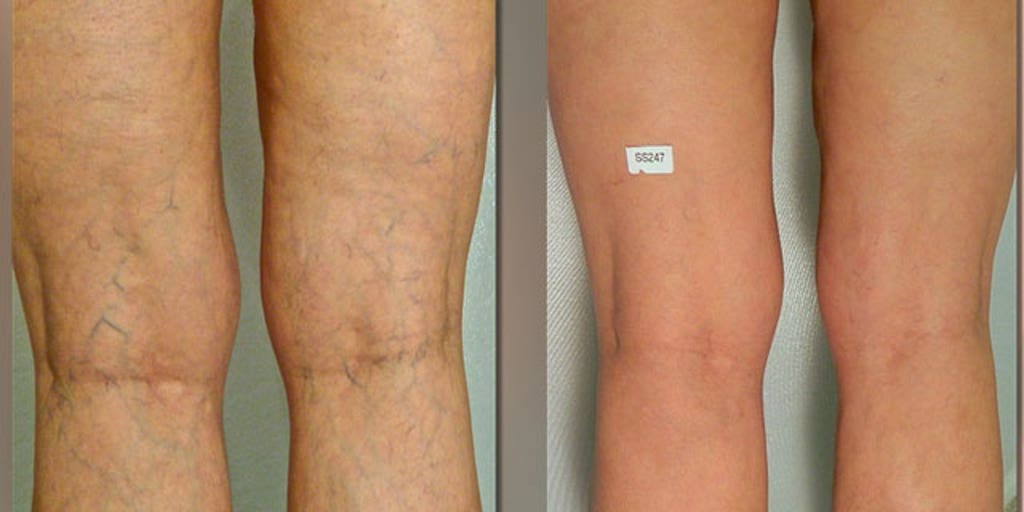 how do you get spider veins how do you get spider veins